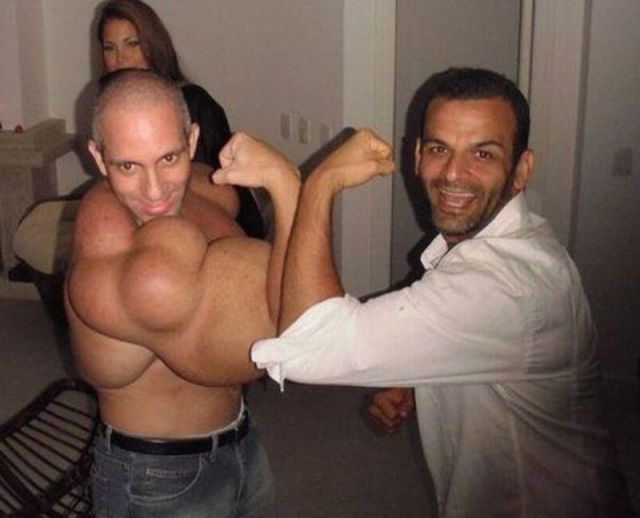 bodybuilder synthol injections