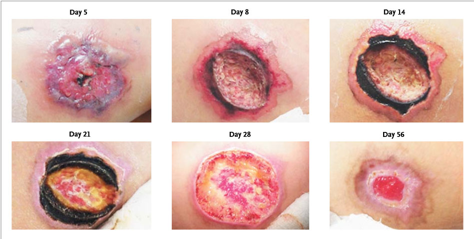 Even though the initial bite is not deadly, it can become fatal if it's not properly treated. Just remember this when you are sleeping tonight.