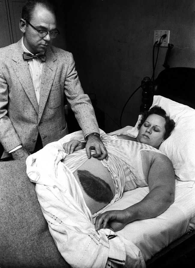 Moody Jacobs shows a giant bruise on the side his patient, Ann Hodges, after she became the only person in history to have been struck by a meteorite.