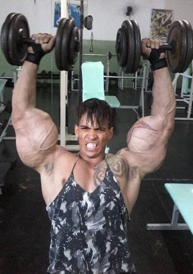 It was all a dream come true for the Brazilian body builder to see his arms bulk up so fast. Then one day, he started feeling unbearable pain in his biceps.