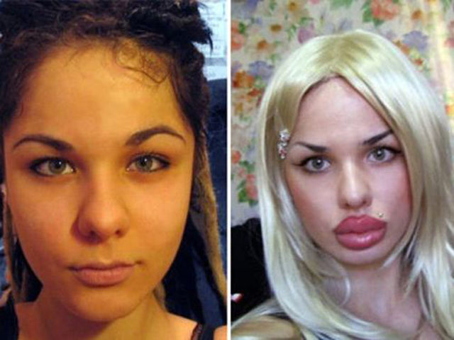 17 Occasions When Plastic Surgery Went Wrong