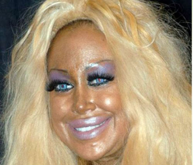 17 Occasions When Plastic Surgery Went Wrong