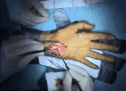 wrist synovectomy