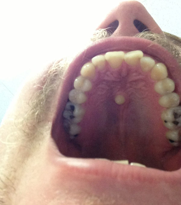 disturbing tooth on roof of mouth