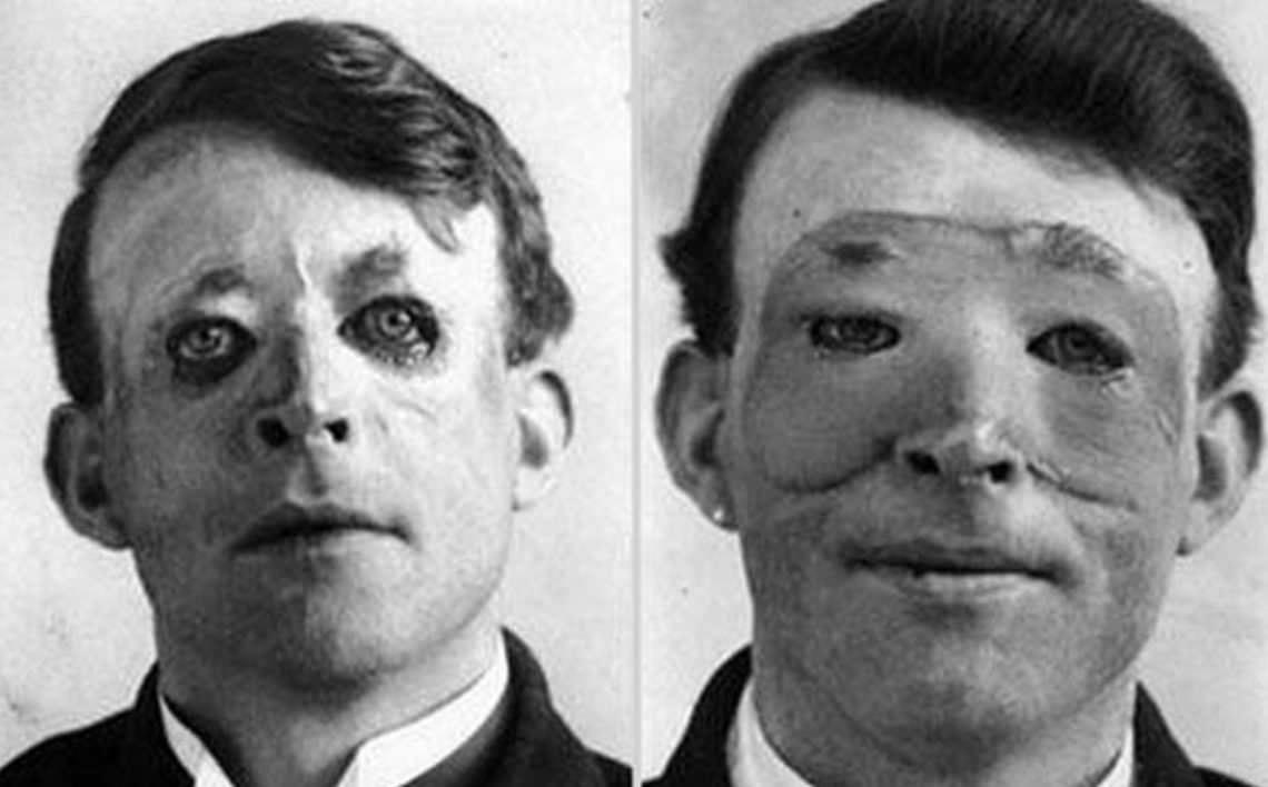 One of the first plastic surgeries ever performed