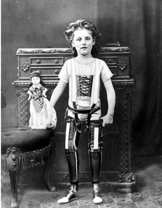 A girl with prosthetic legs, prior to 1900