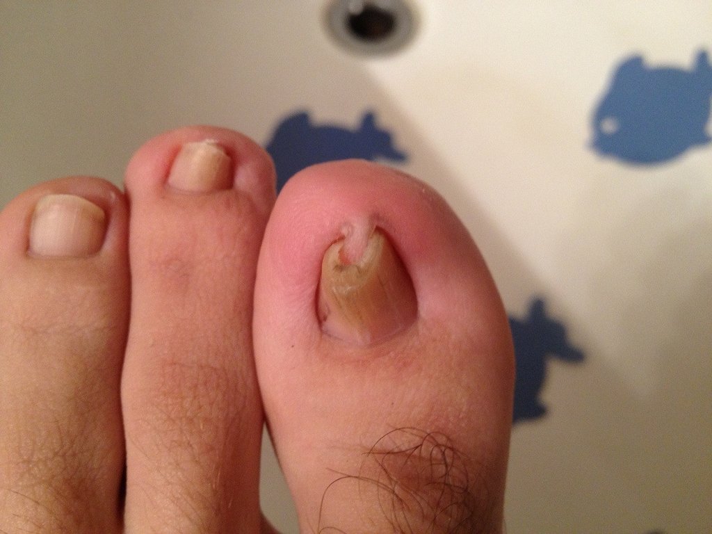 weird toenails