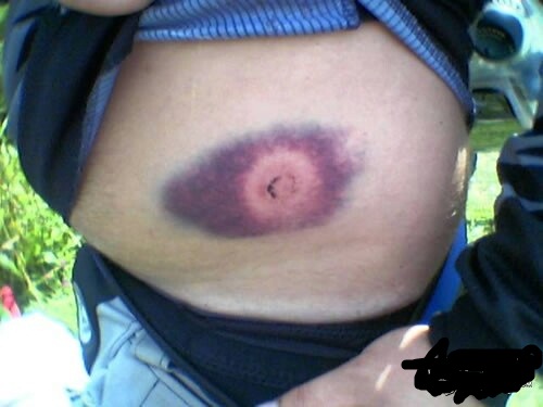 paintball bruise. 