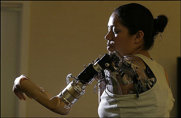 Claudia Mitchell - first woman to have a bionic arm - a prosthetic limb that she controls with her mind.