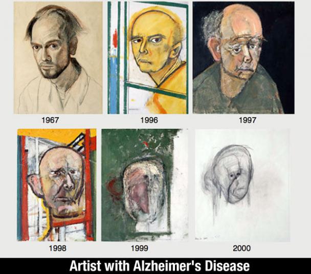 william utermohlen 2001 - 1967 1996 1997 1998 1999 2000 Artist with Alzheimer's Disease