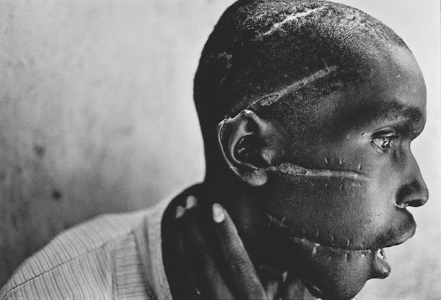A Hutu man at a Red Cross hospital, his face mutilated by the Hutu 'Interahamwe' militia, who suspected him of sympathizing with the Tutsi rebels