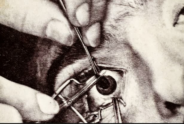 Cutting the irisToday's eye surgeons can laser a hole in a patient's iris the colored portion of the eye in a matter of seconds. But in the late 1800s, doctors used a sharp tool to perform "iridectomy," as shown in this 1870 photograph. Iridectomy allowed the creation of an artificial pupil, restoring sight to those blinded by common infectious and inflammatory disorders.