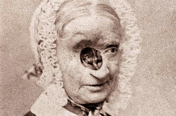 Rodent cancerIn the 19th Century, the cancer now called basal cell carcinoma was known as rodent cancer. That's because patients with advanced cases, like this woman treated in London in the mid-1800s, looked as if their flesh had been gnawed away by rats.