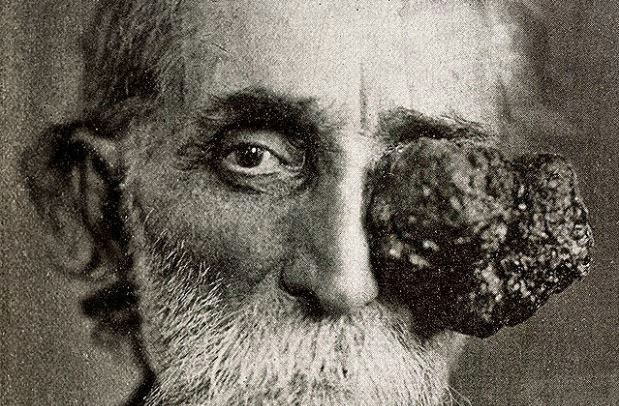 Eye tumorUntil the late 1800s, cancerous growths were often left untreated until they were very advanced, as shown in this 1906 photograph. Surgery was a last, desperate resort - after eye patches no longer sufficed.
