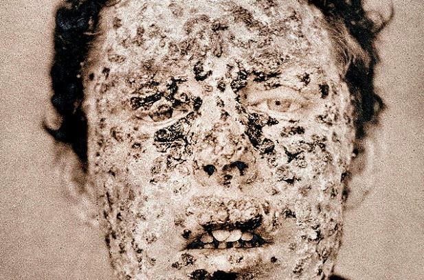 SmallpoxThere hasn't been a case of smallpox in the U.S. since 1949. But between 1900 and 1979, an estimated 300 million to 500 million around the world died of the disease. This photo shows a man infected during an 1881 smallpox epidemic.