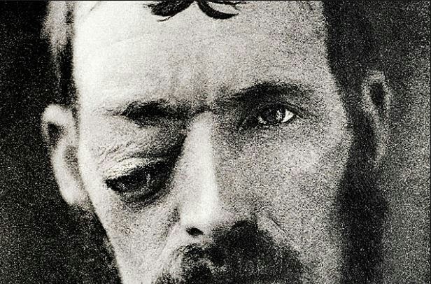 Eye abscessBefore the days of antibiotics, sinusitis and minor respiratory infections could lead to abscesses of the eyes. This 1908 photograph shows a man whose abscess has caused his eye to shift downward.