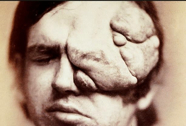 NeurofibromatosisThis photograph first appeared in 1871 in the first medical photographic journal. It shows a patient with von Recklinghausen's disease, a disfiguring hereditary disease now known as neurofibromatosis. There is still no cure for the disease. Patients often have the "fibromas" surgically removed - unless they are too big or too numerous to remove.