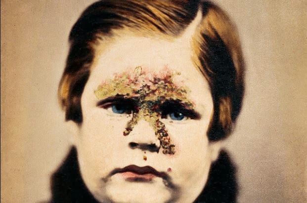 ImpetigoNow rare, the bacterial infection known as impetigo was common in the 19th Century. This photo appeared in 1865 in an English textbook on skin disorders. It shows a child with pustules typical of the disease. Impetigo is typically seen in children, often following a cut, abrasion, or insect bite.