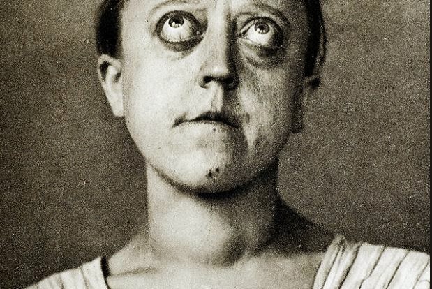 Bulging eyesHyperthyroidism - the same disorder that causes goiters - can also cause bulging eyes, as shown in this 1908 photograph. As the eyes protrude, the tend to dry out, sometimes resulting in scarring, infection, and blindness. Hyperthyroidism is also known as Grave's disease.