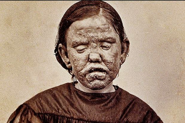 LeprosyThis 1867 photograph shows a woman with a form of leprosy known at the time as "elephantiasis des Grecs." It first appeared in a French medical text published in 1868, "Clinique photographique de l'hospital Saint-Louis." Three years later, in 1871, this dreaded disease - which affects the eyes and causes enlargement of various parts of the body - was found to be caused by a bacterium.