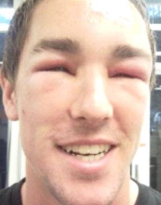 20 Crazy Bee Sting Faces