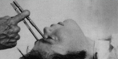Lobotomies:      Lobotomies were a popular fad for the first half of the 20th century and were floated as a "cure" for pretty much any mental issue you can name, from conditions as serious as schizophrenia to something as mild as depression or anxiety.
