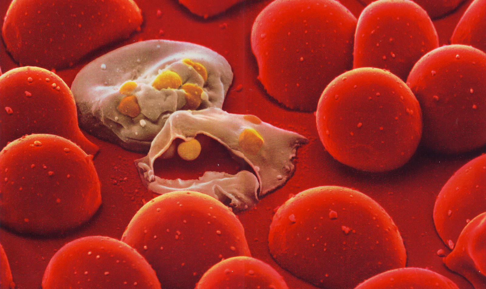On the attack     Malaria protozoa have multiplied in two cells in a culture dish of red blood cells. One has burst open releasing the parasites to infect other cells