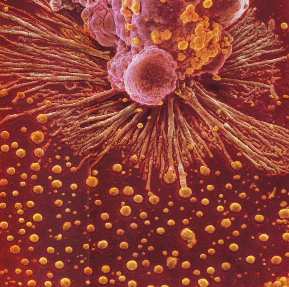 A macrophage x18000, a human defense cell, seeking to engulf droplets of oil.