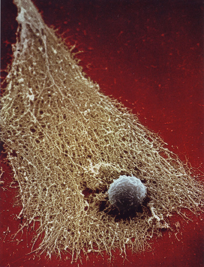 Victory        After a cancer cell loses its cytoplasm, only a fibrous skelleton is left, here surrounding a T-cell.