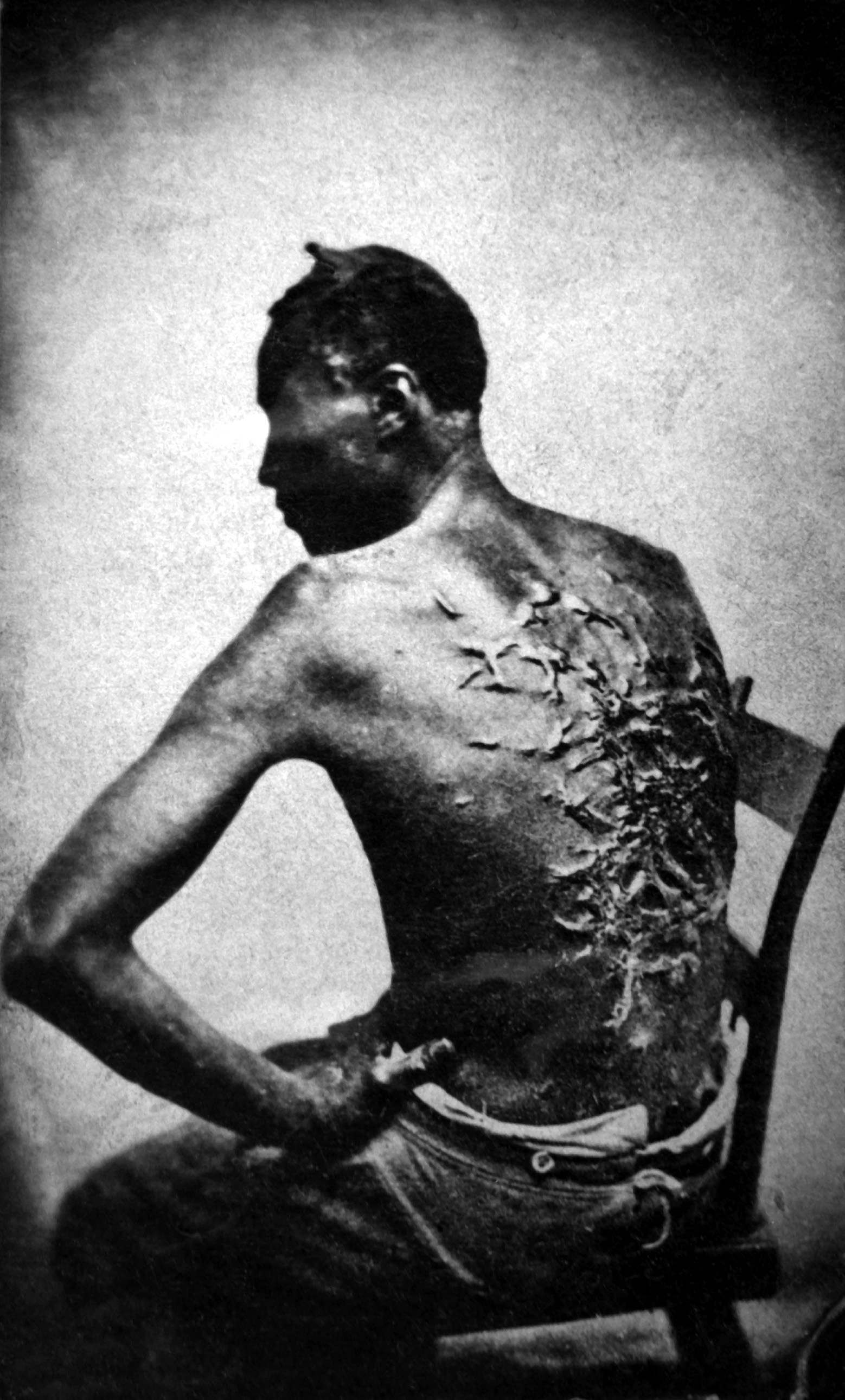 Scars of a whipped slave April 2, 1863, Baton Rouge, Louisiana