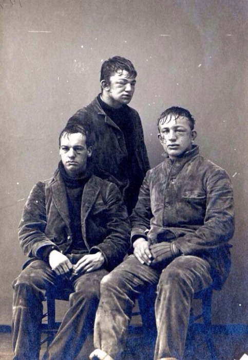 Injuries suffered from the 1892 Princeton freshmen/sophomore snowball fight…