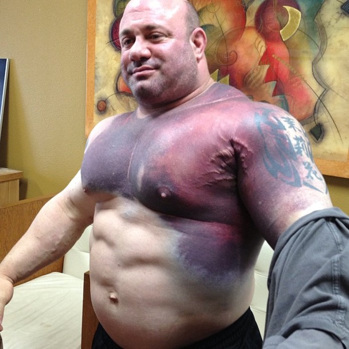 Scott Mendelson after he tore his pec trying for the world record bench press (716.5 lb)