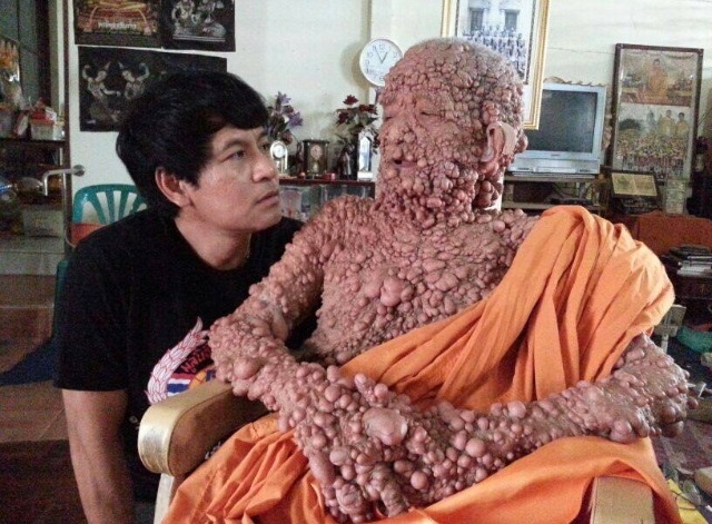 A Buddhist monk in Thailand With Neurofibromatosis