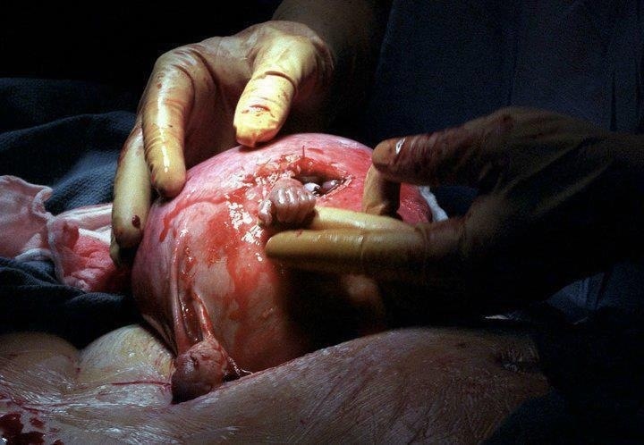 Hand of Hope – A unborn baby pulls out his hand out of the incision made in the uterus of his mother during an operation and suddenly grabs the hand of the surgeon.