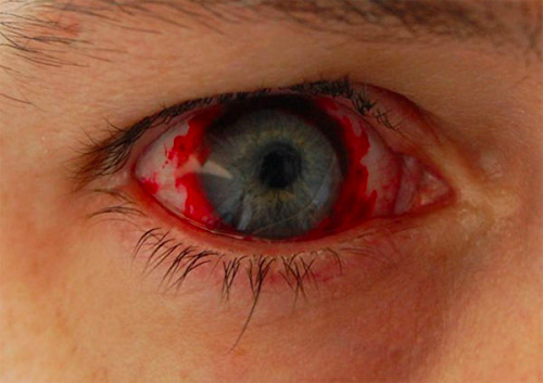 bloody contact lenses