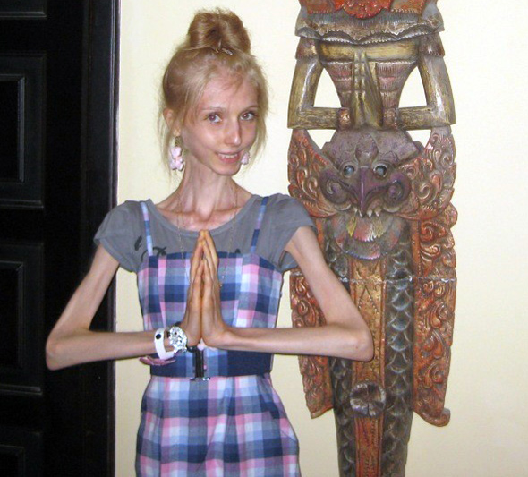 Anorexic Girl