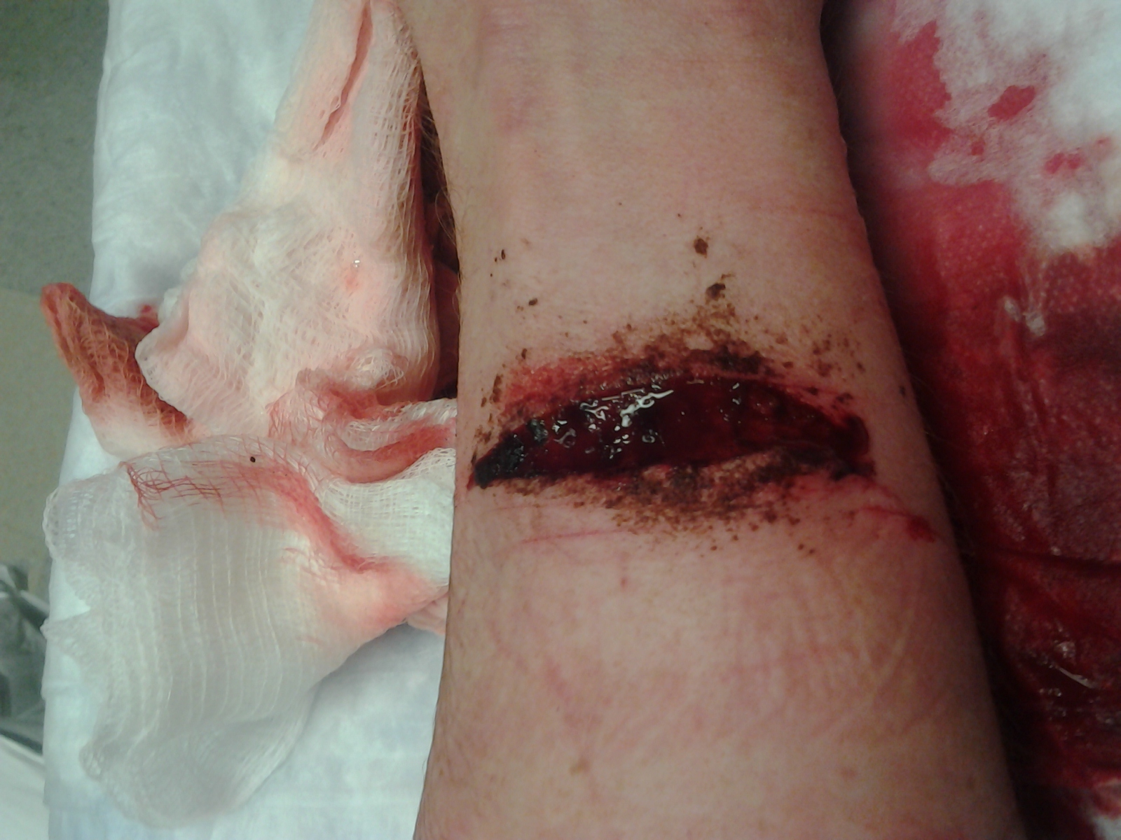 After they cleaned the wound I could see my tendons moving.