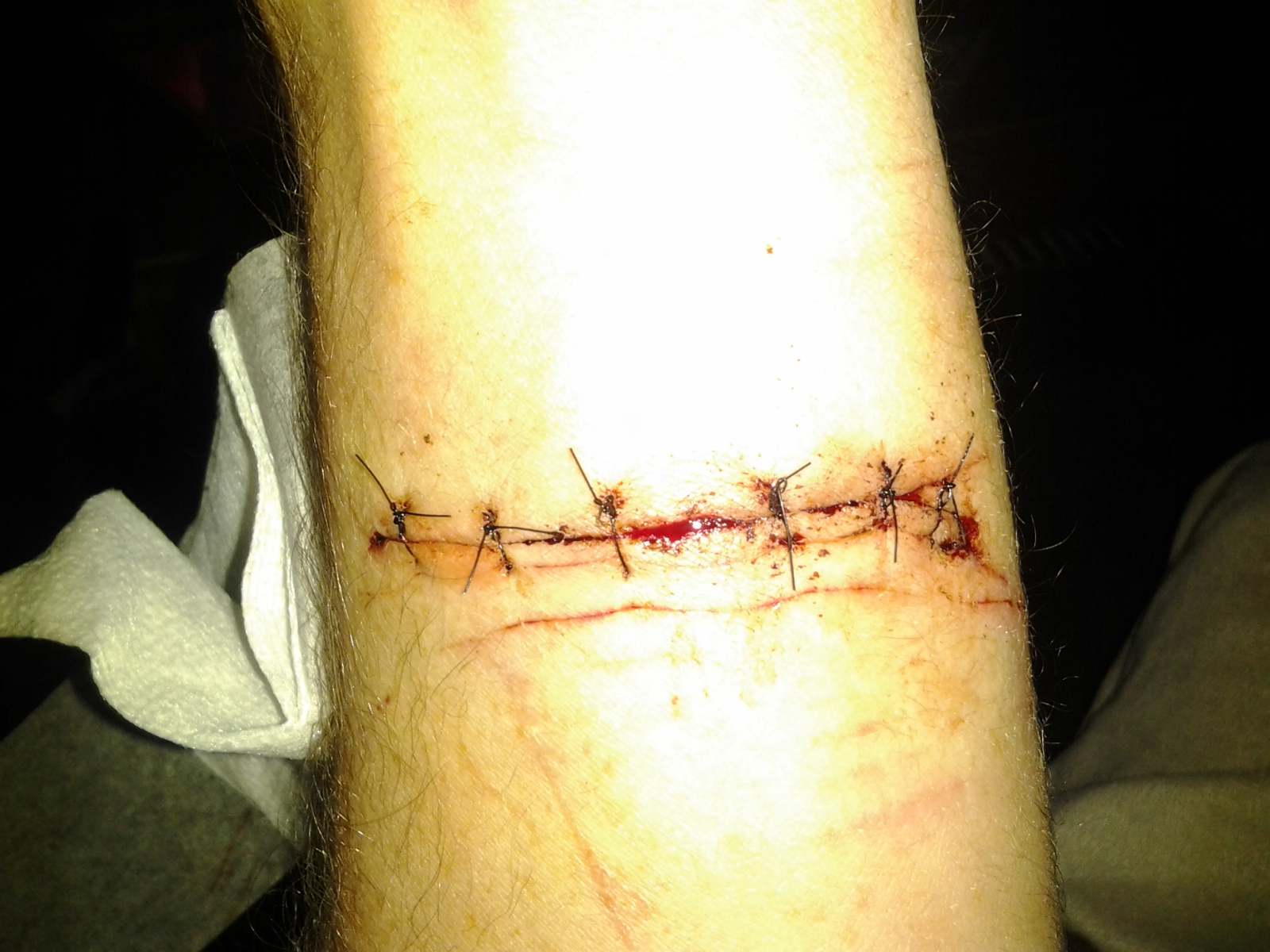 six stitches