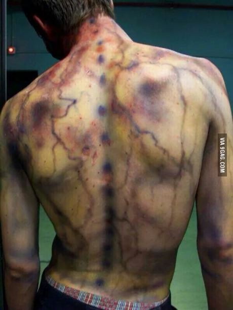In case anyone wanted to know what a lightning strike can do to the body. Given that they survive.