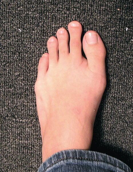 Morton's Toe: When your second toe is bigger than your big toe.