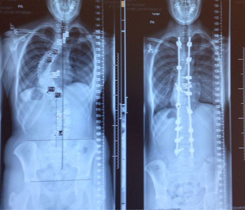 X-rays showing before and after treatment of scoliosis.