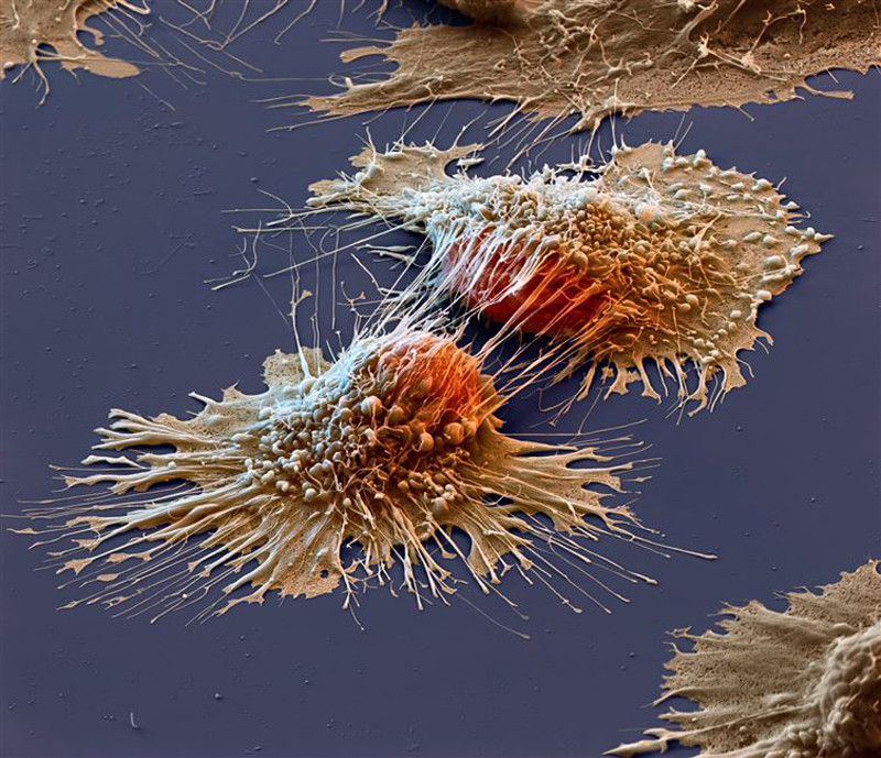 Cancer cells under  microscope.