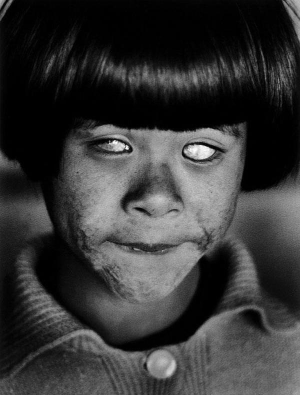Hiroshima, 1945 a child left blind from the atomic bomb.