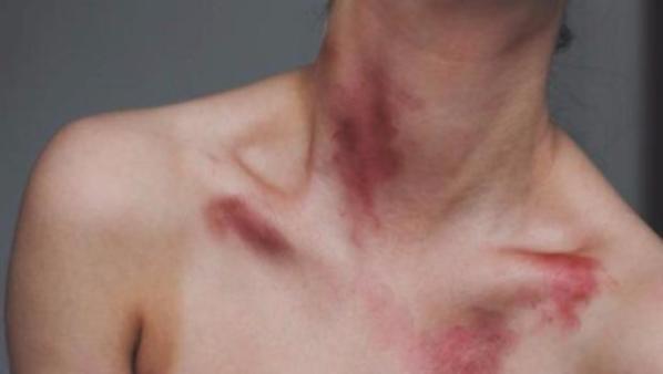 When you were in high school, you probably gave and received some hickeys, they seem innocent enough, but there can be complications.
Hickeys typically appear on the neck and chest and are a form of bruising caused by a person sucking or biting on the flesh. They look bad until they disappear a few days later, but that’s the least of your worries