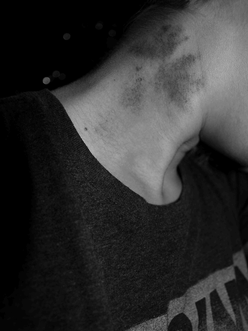 Do you bruise easily? If hickeys show up super-easy on your skin and stay for a long time, it’s likely that you have an iron deficiency.
