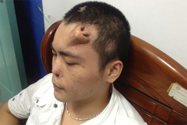 Xiaolian from China suffered a nasal injury in a car accident and doctors replaced his nose.