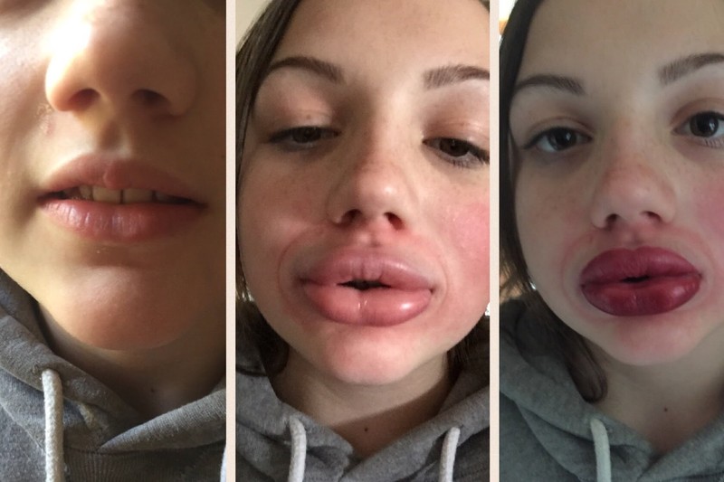 Kylie Jenner lip trend disaster.  Not all the girls are making it perfect.