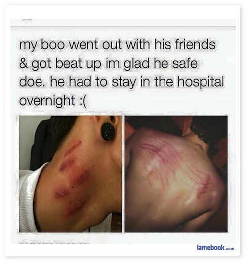 hickies on butt - my boo went out with his friends & got beat up im glad he safe doe. he had to stay in the hospital overnight lamebook.com