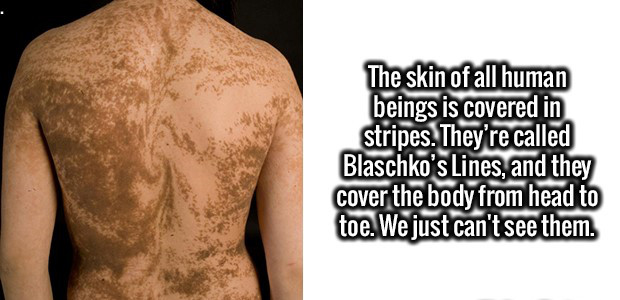 shoulder - The skin of all human beings is covered in stripes. They're called Blaschko's Lines, and they cover the body from head to toe. We just can't see them.