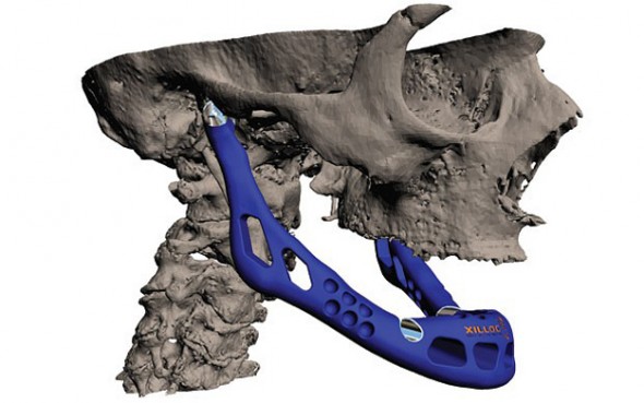 Custom Jaw Transplant Created With 3-D Printer